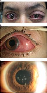 Image result for Dacryoadenitis