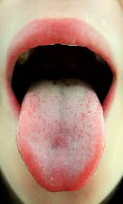 Tongue With Images Burning Mouth Syndrome Bad Breath Burning Tongue Syndrome