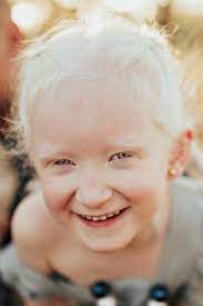 Smaller amounts of eumelanin make a person's hair blonde, while larger concentrations make it brown. White Hair White Eyelashes Child Albino Albinism Red Eyes Pale Skin Not Like All Albinism Albino White Haired Child