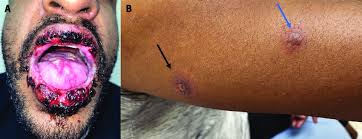 Image result for Erythema Multiforme Major