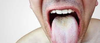 Uncomfortable and unattractive, oral thrush is both painful and problematic. Mundsoor Hefepilzinfektion Des Mundes Hautstadt