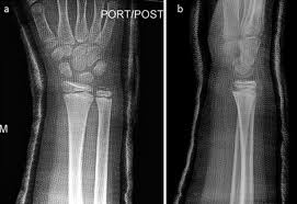 Image result for Short Arm Cast