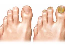 La onicomicosis o infección por hongos, es la afectación que más  frecuentemente puede dañar a las uñas, y suele perjudicar principalmente a  las uñas del pie. - Clínica DKF