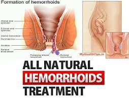 Pin On Home Remedies