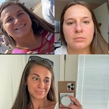 Breast Implant Illness and Removal Struggles