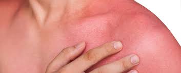 We share our favorite snorkeling sunscreens after testing many. Heat Rash Sun Rash What S The Difference Osf Healthcare