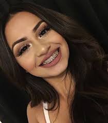 Sorria Mesmo Que Tenha Um Monte De Ferro Nos Dentes Apenas Sorria Aparelho No Dente Aparelho De Dente Aparelho Dental