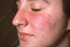 Image result for Photodermatitis