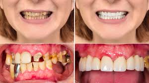 An occlusal cant (crooked smile) can usually be corrected using porcelain veneers. How To Make Your Teeth Look Better Smile Angels Of Beverly Hills