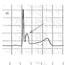 Jun 30, 2017 · a presença de dor torácica deve ser caracterizada como aguda ou pleurítica. A 12 Lead Electrocardiogram Recorded In A Patient With Acute Download Scientific Diagram