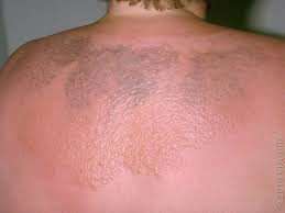 Image result for Sunburn
