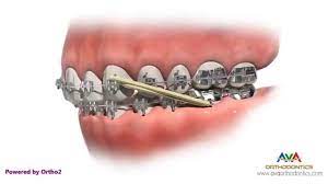 You can think of this as the opposite of an overbite where the lower jaw juts out further rubber bands may be a bit uncomfortable at first, because they are pulling your teeth into alignment. Orthodontic Treatment For Overjet Overbite Rubber Bands Youtube