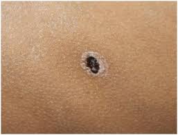 Escharotomy simply means opening the eschar. Jcdr Eschar Orientia Tsutsugamushi Rickettsial Disease