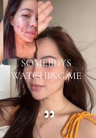 7 Days Acne Marks Journey Update