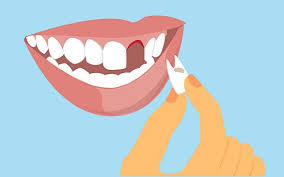 Parents are advised to never pull out a milk tooth unless it's only hanging by the smallest tissue thread. How To Pull Out A Loose Tooth