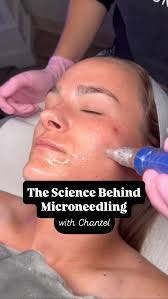 Microneedling works with your skin’s natural healing power. Tiny,  controlled micro-injuries trigger your body to ramp up collagen and elastin  production. Key proteins that keep skin firm, smooth, and ...