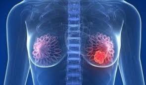 Resultado de imagem para cancer de mama