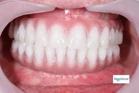 Denture Implants Vs Fixed Bridge Teeth Replacement Options False Teeth