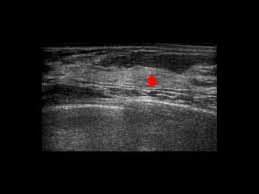 Depending on your symptoms, your doctor makes a diagnosis based on a combination of tests and procedures. Sonocine Sonogram Results For Breast Cancer Detection Youtube