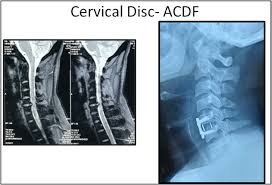 Mild to sharp pain in the neck, shoulders or lower back. Cervical Disc Disease And Cervical Spondylosis Cervical Slip Disc Presents With Neck Pain And With Nerve Compression Produces Sharp Current Like Pain In Arm Forearm And Sometimes In Upper Back Neck Pain