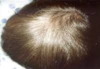 Fluoride intake through groundwater would lead to hypothyroidism whose one of the symptoms is hair loss. Hair Loss In Children