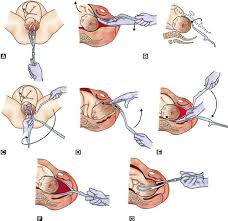However, when used correctly and with gentleness they can achieve a controlled, atraumatic delivery. Jaypeedigital Ebook Reader