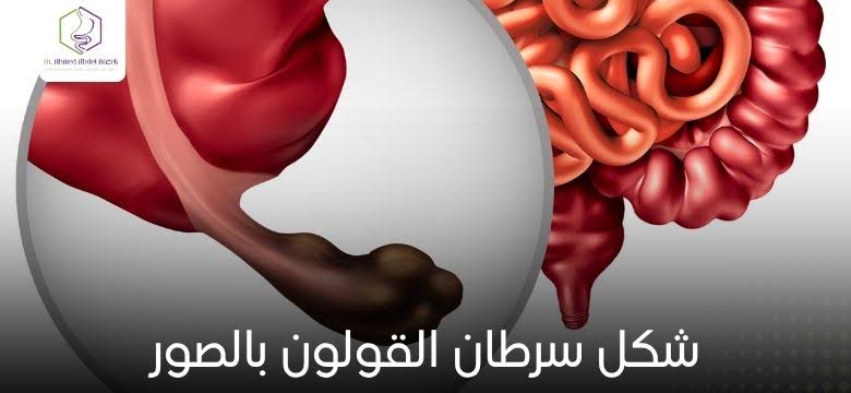 شكل سرطان القولون بالصور