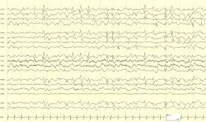 Image result for Absence Seizure