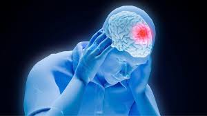 Image result for Spinal Headache