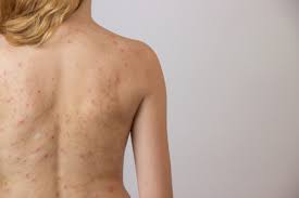 Die erkrankung geht von den talgdrüsen aus, deren ausscheidung gestört ist, es findet eine gestörte. Steroidakne Ursachen Beschwerden Therapie Gesundpedia De