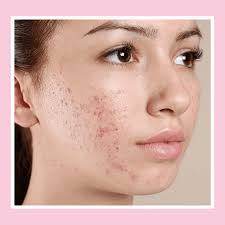 Image result for acne face