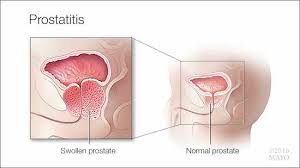 Image result for Acute Bacterial Prostatitis