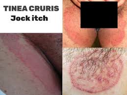 Image result for penis mycosis symptoms