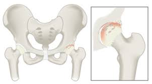 If they are painful or have arthritis, you'll have pain as you stand up because this puts pressure on the painful joints. Common Causes Of Hip Pain Summit Orthopedics