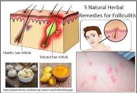 Herbal Remedies For Folliculitis Natural Herbal Remedies Herbalism Herbal Remedies