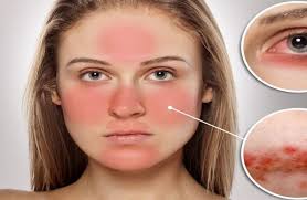 مرض الذئبة هو مرض مناعي ذاتي مزمن يمكن أن يتلف أي جزء من الجسم (مثل: Ø§ÙØ°Ø¦Ø¨Ø© Ø§ÙØ­ÙØ±Ø§Ø¡ Ø§ÙÙ Ø§Ø³Ø¨Ø§Ø¨ Ø§ÙØ°Ø¦Ø¨Ø© Ø§ÙØ­ÙØ±Ø§Ø¡ Ø¹ÙØ§Ø¬ Ø§ÙØ°Ø¦Ø¨Ø© Ø§ÙØ­ÙØ±Ø§Ø¡ Ø§Ø¹Ø±Ø§Ø¶ Ø§ÙØ°Ø¦Ø¨Ø© Ø§ÙØ­ÙØ±Ø§Ø¡ Ø¯ Ø§ÙØ¹ÙØ§Ø¯