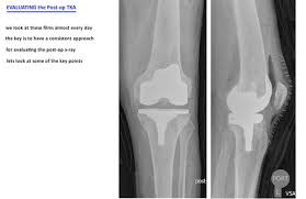 Image result for Knee XRay