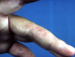 Eczema and diet are intimately related with these 8 foods most likely to be a trigger for symptoms of itchy, red skin to quickly appear. Nickel Allergy Dermnet Nz