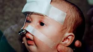 Simak 5 Cara Merawat Bayi dengan Pierre Robin Syndrome