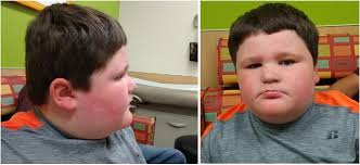 Cohort Expansion and Genotype-Phenotype Analysis of RAB11A-Associated  Neurodevelopmental Disorder