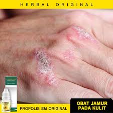 Kamu harus ke dokter kulit untuk mengobati yang satu ini. Obat Kulit Jamur Kulit Kepala Kulit Kering Obat Kulit Gatal Obat Kulit Penghilang Gatal Jamur Shopee Indonesia