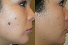 Home Mole Removal How To Skin Moles At Home Remedies Products Kits On Face Mole Removal Home Remedies For Skin Skin Moles