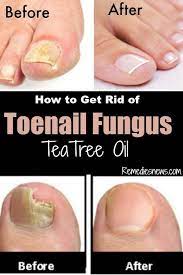 How To Get Rid Of Toenail Fungus Before And After With Tea Tree Oil Fast Remedy Toenail Fungus Remedies Toenail Fungus Tea Tree Oil For Acne