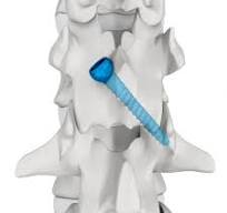 Percutaneous MIS Facet Screw,Medical Device Manufacturers ...