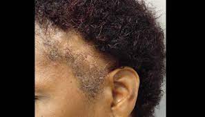 Alopecia areata (aa) is one of the most common causes of localized hair loss. Patchy Hair Loss On The Scalp Clinical Advisor