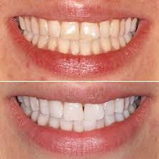 Nov 11, 2020 · how long does it take to whiten teeth with zoom? How Long Does Zoom Teeth Whitening Last Cosmetic Dentistry London Bridge Whites Dental