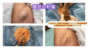 動画 - 東京皮膚のできものと粉瘤クリニック ふるばやし形成外科 新宿院