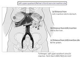 Poet laureate, most recently in 2000. Best Access To The Abdomen Ppt Video Online Download