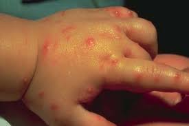 Image result for Fire Ant Sting