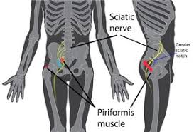 Learn about the possible causes of sciatica and the various treatment options such as medications, exercise, surgery, and steroid injections. Yoga For Sciatica 9 Poses For Relief Prevention Arhanta Yoga Blog